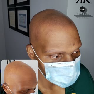 Only one session and Alopecia Totalis goes down. KO. 🥊
Soft, natural, undetectable, imperfectly per
