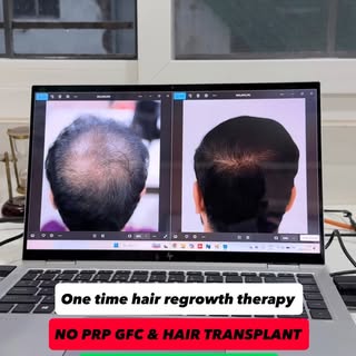 Hair thinning? Hair fall? Visible bald patches? 👀

FSCT (Follicular Stem Cell Therapy) is an advanc
