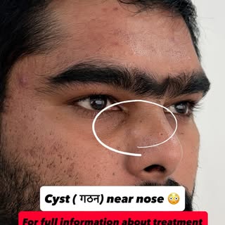 Cyst Removal Surgery in Nagpur | Safe, Effective & Minimal Scar Treatment

Do you have a sebaceous c
