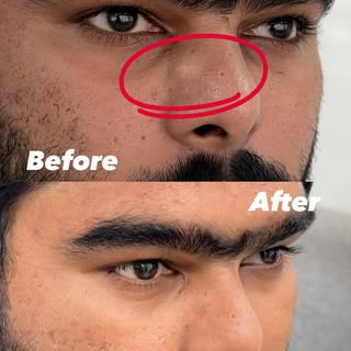 Cyst Removed Successfully with Excellent Results!

Say goodbye to painful or unwanted cysts with saf