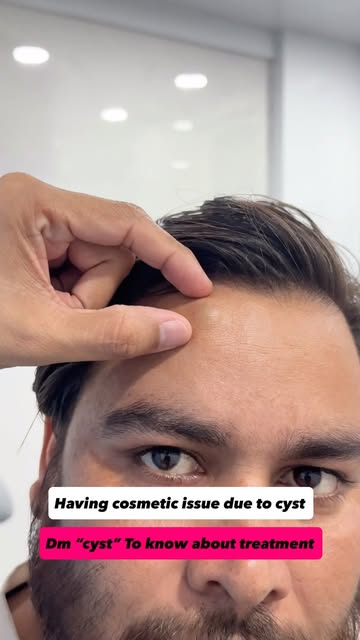 Getting a cosmetic concern due to a cyst?

A visible cyst can affect your appearance and confidence,