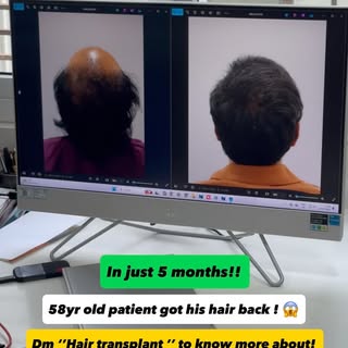 58 years old. A new chapter for his hair. 

A remarkable hair transplant transformation for our 58-y