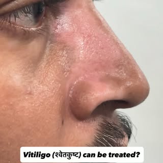 Vitiligo can be treated. 
With the right diagnosis and a personalized treatment plan, improvement is