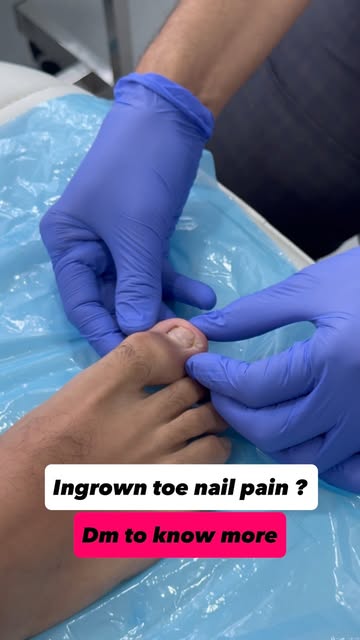 👣 Painful Ingrown Toenail? Don’t Ignore It!

An ingrown toenail can cause pain, swelling, redness, 