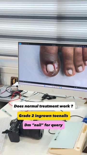 Grade 2 Ingrown Toenail — Treated with Expert Care!

Pain, swelling, redness or recurring infection 