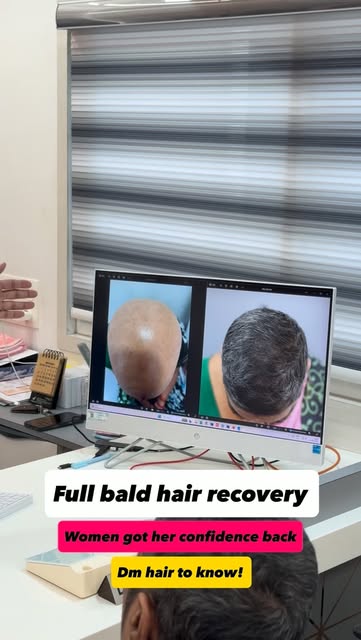 From a completely bald scalp to visible hair regrowth 

A remarkable hair regrowth journey at Radian