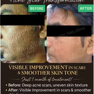 From Scars to Confidence! ✨
Visible improvement in acne scars after consistent treatment.
Every skin