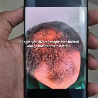 Hair Regrowth is Science, Not Luck.
Through a combination of advanced protocols — PRP, Growth Factor