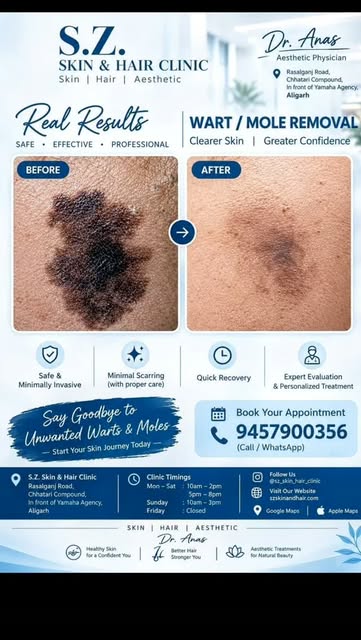 Bye-bye, unwanted warts & moles ✨
A visible skin concern can affect more than just your appearance—i