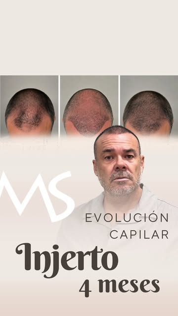 ✨ 4 meses después de su injerto capilar… y esto no ha hecho más que empezar.

Hoy compartimos la evo
