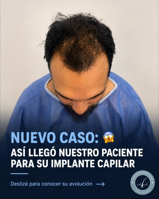 ✨ Un nuevo caso de trasplante capilar

Hoy te mostramos el proceso de un paciente que llegó con pérd