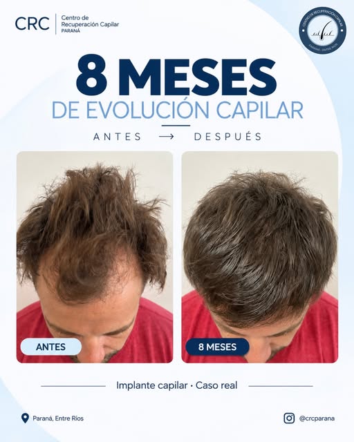 ¿Querés recuperar densidad y mejorar tu línea frontal? 👀✨

Conocé este caso real de implante capila