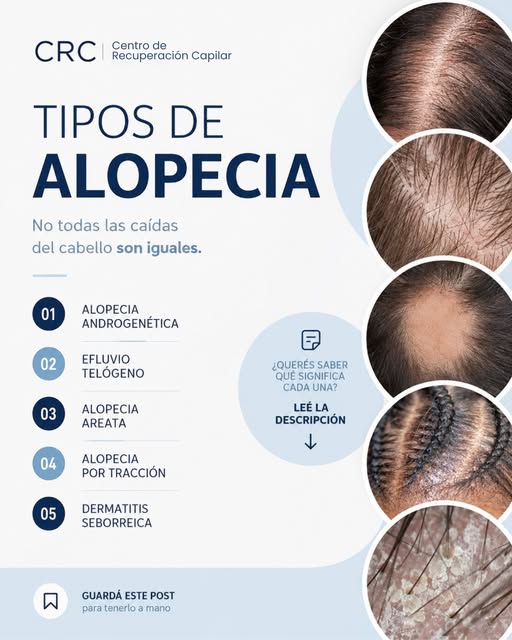 ¿Sabías que existen distintos tipos de alopecia? 🧑🏻‍⚕️

La caída del cabello no siempre tiene la m