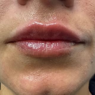 Buze conturate natural, cu volum discret și armonie facială.
Scopul unei augmentări reușite nu este 