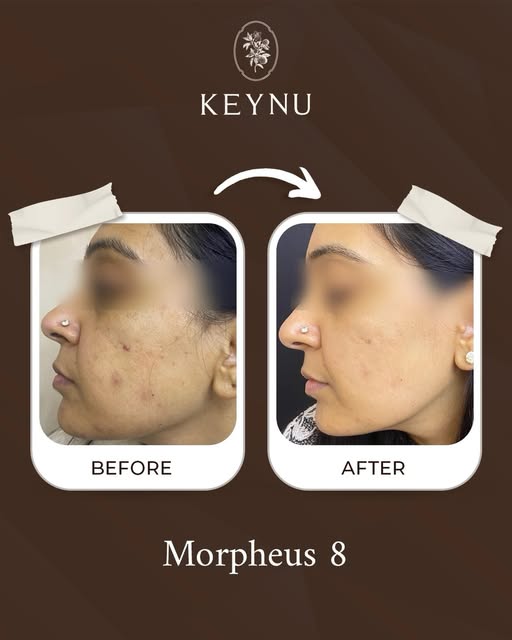 Skin, refined with precision. 
A visible improvement in acne scars, open pores & overall texture wit