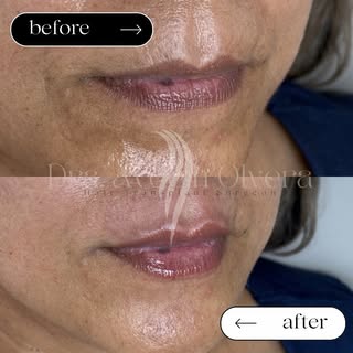 Hidratación de labios con 
Acido Hialurónico
Técnica Baby Lips 👄