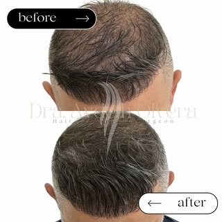 UPDATE
 A solo 4 meses de Protocolo personalizado de tratamiento médico con @bioskincell , SIN cirug