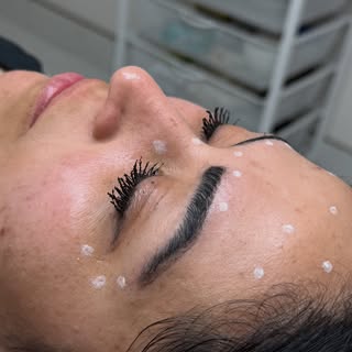 S W I P E > > > for a Before

Eyebrow Transplant Surgery can bring back the frame of your whole face