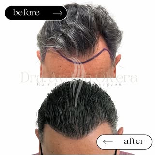 6 MONTH UPDATE
Hair Transplant Surgery 🌱✨

You too can achieve natural results alongside Dr Olvera,