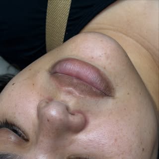 SWIPE > > > for a Before
Patient After 2 sessions of BACIO
Hydration + Plump Effect + Natural Color 