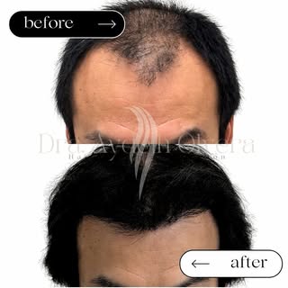 7 MONTHS UPDATE
Hair Transplant Surgery ✨

We work to deliver long lasting and aesthetic results 🙏
