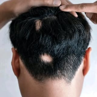 Alopecia Areata Awareness!