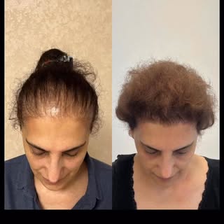 Danışanımız hülya hanımın 8. Ay sonucu 🌹☺️ 

.
.
.
#ankarasaçekimi #kaşekimi #hairtransplant #kesfe