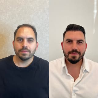 Danışanımızın 8. Ayı ✅

#hairtransplant #saçekimi #keşfetteyiz #ankara