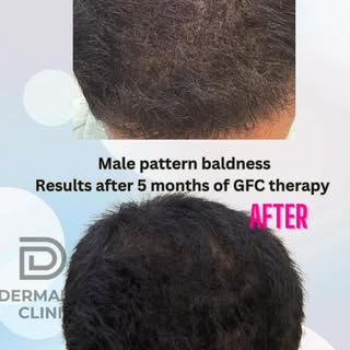 Real Results: Hair Growth After 3 GFC Session  Seeing is believing! 💇‍♂️💇‍♀️
Our patient achieved 