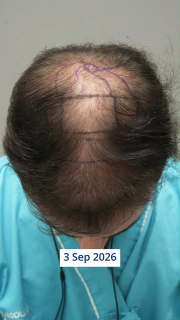 Bring Your Confidence Back ✨

As we get older, hair loss and thinning hair are pretty common for man
