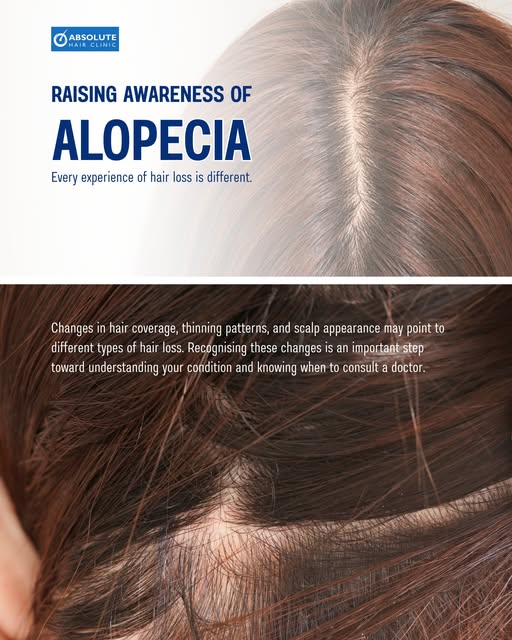 September is Alopecia Awareness Month, a time to highlight the different forms of alopecia and their