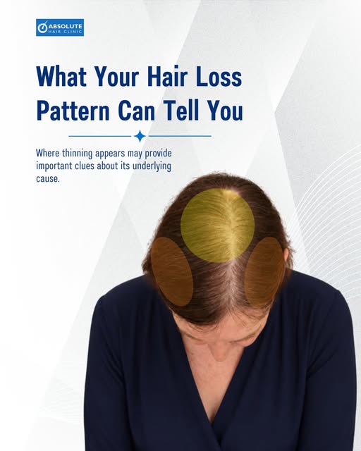 Hair loss can present in many different ways, and the pattern of hair loss can provide valuable clue