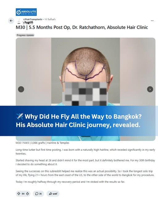 ✈️ 21+ hours from the US to Bangkok.
3,066 grafts. 5.5 months. A new hairline.
And the journey conti