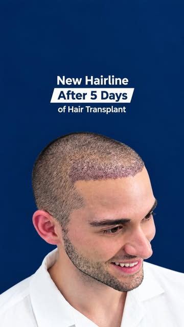 Day 5 update for our hair transplant patient! Grafting looks strong and healing smoothly. Caring for