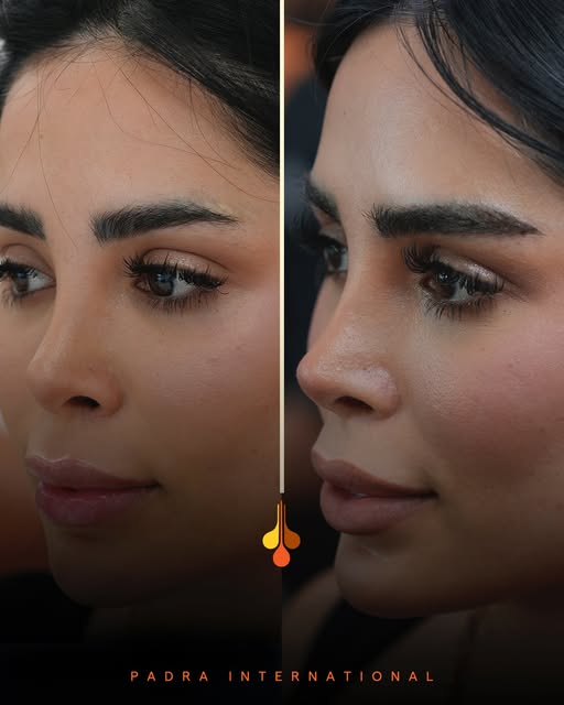 تفاصيل دقيقة… وحواجب بمظهر طبيعي. ✨🤍
📍 بواسطة شركة بادرا إنترناشيونال لحجز المصحات العلاجية

Preci