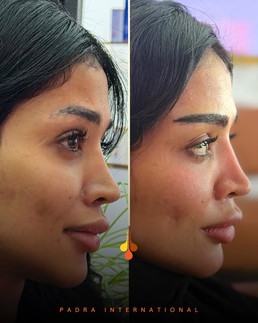 تفاصيل صغيرة… تصنع فرقًا كبيرًا في ملامحك. ✨🤍
حواجب أكثر امتلاءً، وتناسق يمنحك مظهرًا طبيعيًا.
📍 ب