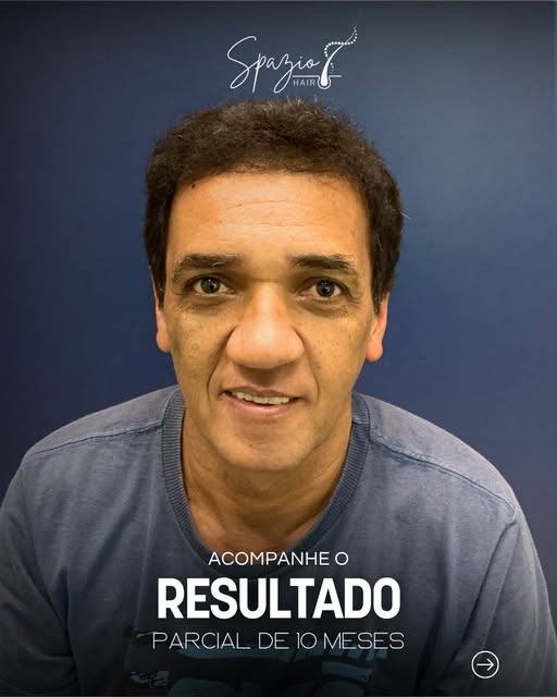Cuidar do cabelo também é cuidar da autoestima.

Resultado Parcial de 10 meses;
Técnica: FUE HD Rege