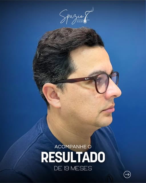 Um resultado que transforma a aparência e a forma de se enxergar.

Resultado de 19 meses;
Técnica: F