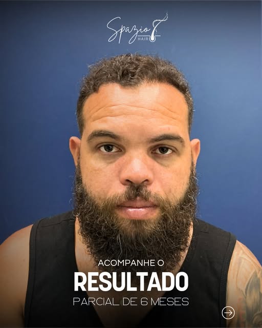 Quando a autoestima volta, a confiança acompanha.

Resultado Parcial de 6 meses;
Técnica: FUE HD Reg