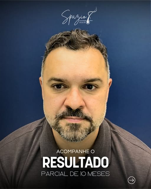 Cada resultado conta uma nova história.

Resultado Parcial de 10 meses;
Técnica: FUE HD Regenerativo