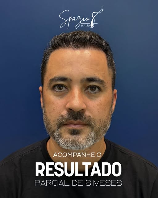 Resultado de 6 meses;
Técnica: FUE HD Regenerativo
Punch utilizado: 0,85 mm

3.030 Folículos | 7.266