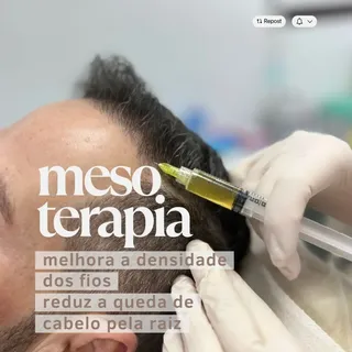 **Mesoterapia capilar: cuidar da raiz para transformar o fio. 🌿**

Quando a queda e a perda de dens