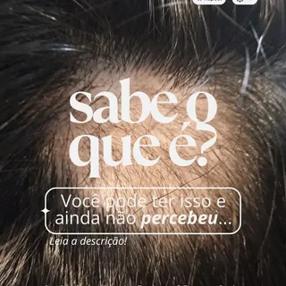 A alopecia areata é uma condição autoimune, que acomete principalmente pessoas com alto nível de est