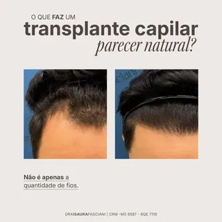 Um transplante capilar de qualidade não é medido apenas pela quantidade de fios implantados.
‌
A nat