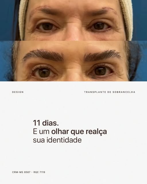 Não se trata apenas de preencher uma sobrancelha.
‌
Cada folículo é retirado individualmente e impla