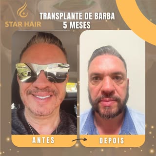 Transforme sua autoestima com um transplante de Barba na Star Hair!

Olhe bem para os nossos resulta