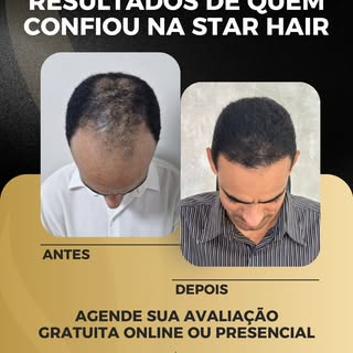 Transformação real, autoestima renovada! ✨

Confira o resultado de 7 meses pós transplante capilar r