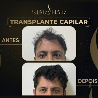 ✨ Mais um resultado incrível.

Não é apenas sobre recuperar cabelos. É sobre recuperar a confiança a