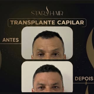 ✅ 4 meses pós transplante capilar.

Antes, as entradas incomodavam. Hoje, o espelho mostra exatament