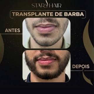 ⏳ 1 ano depois e o resultado fala por si! 

Uma barba mais preenchida, natural e desenhada faz toda 